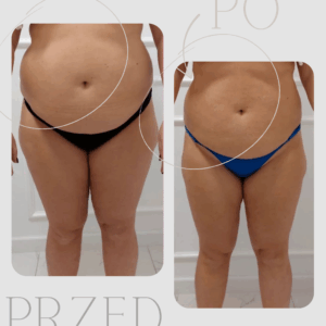 👻🎃💀BLACK FRIDAY MONTH - TYLKO 30 VOUCHERÓW: Icoone zabieg wyszczuplający, antycellulitowy, ujędrniający aż po 60min!