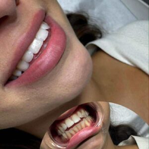 👻🎃💀BLACK FRIDAY MONTH - TYLKO 30 VOUCHERÓW: Wybielanie zębów lampą 339zł zamiast 800zł!